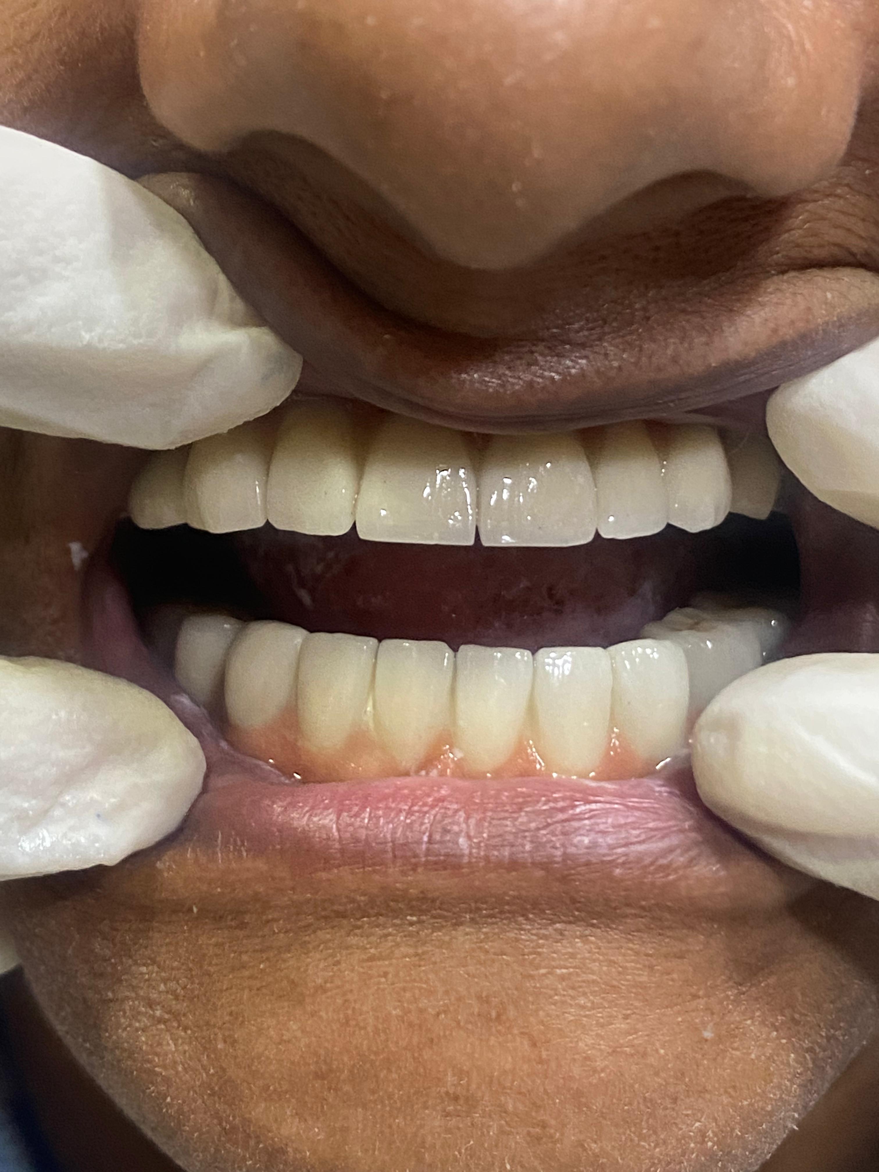 Before Treatment